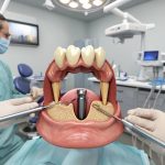 YourMed: Наша история улыбок - от сомнений к уверенности в имплантации